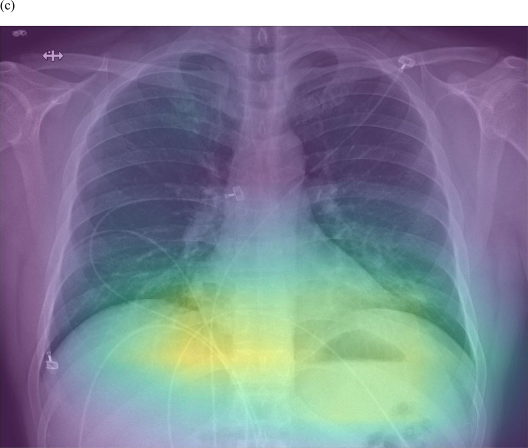 Chest radiograph demonstrating bilateral pulmonary opacities consistent with acute respiratory distress syndrome with diffuse ground-glass and consolidative changes