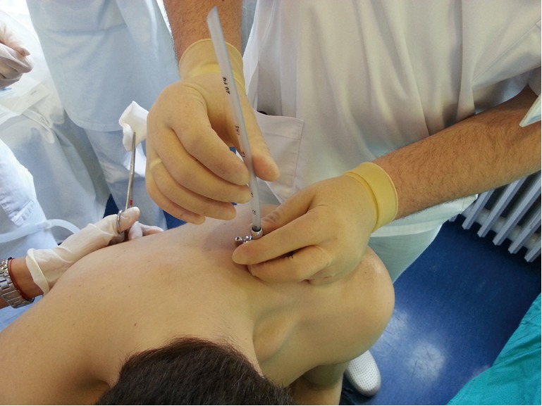 Step-by-step chest tube thoracostomy insertion technique showing incision, blunt dissection, and tube placement into the pleural space