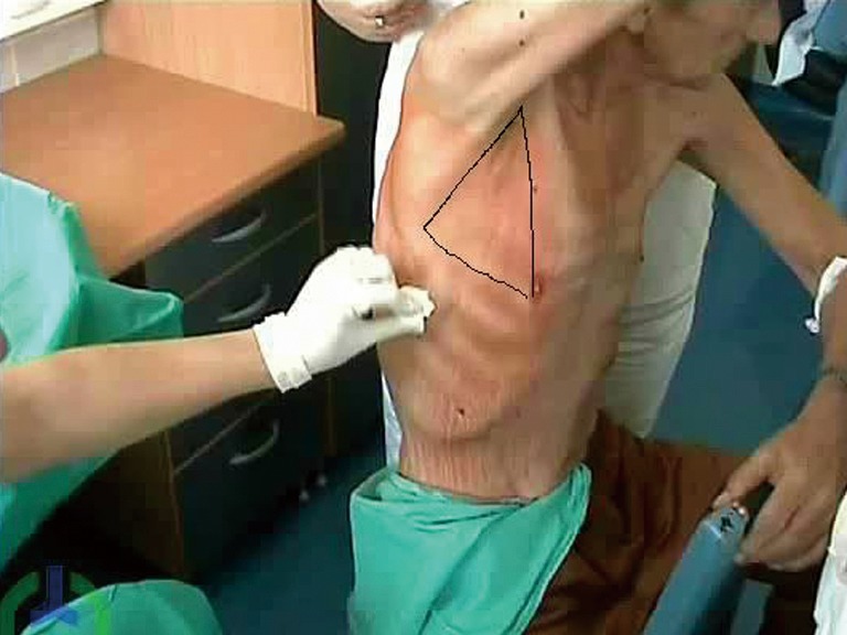 Anatomical landmarks of the safe triangle for chest tube insertion showing the boundaries formed by the pectoralis major, latissimus dorsi, and fifth intercostal space