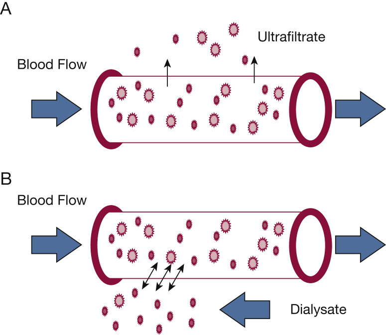 Schematic comparison of CRRT modalities showing CVVH convective clearance, CVVHD diffusive clearance, and CVVHDF combined clearance with circuit components