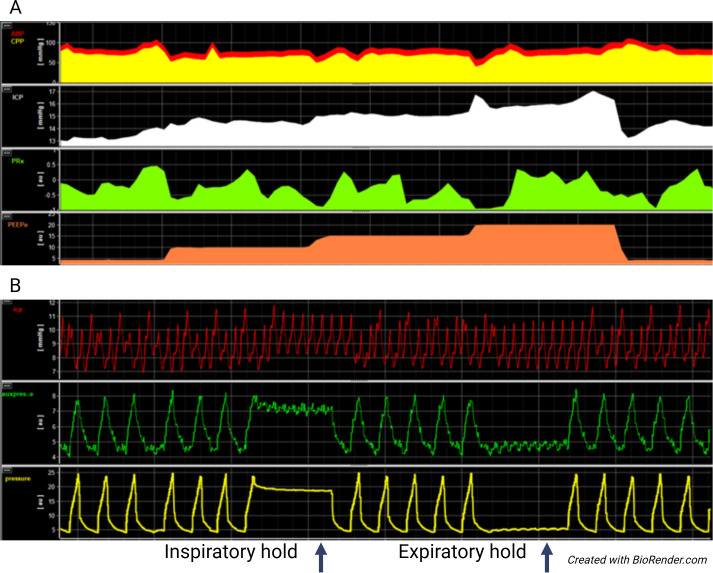 Multimodal neuromonitoring traces showing simultaneous arterial blood pressure, intracranial pressure, cerebral perfusion pressure, and airway pressure waveforms in a neurocritical care patient
