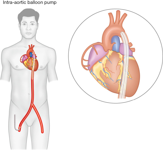 Diagram of intra-aortic balloon pump showing inflation during diastole and deflation during systole