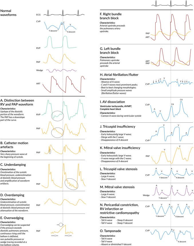 Common pitfalls and abnormal waveform patterns encountered during pulmonary artery catheter use