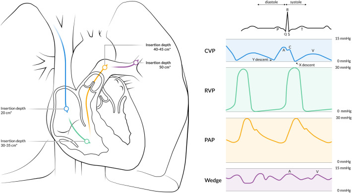 Pulmonary artery catheter placement showing sequential waveform changes from right atrium through right ventricle to pulmonary artery and wedge position