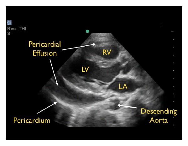 Echocardiographic image of pericardial effusion with right atrial and right ventricular diastolic collapse consistent with cardiac tamponade physiology
