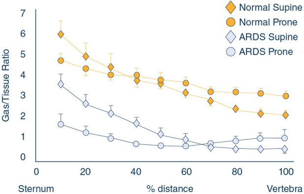 Diagram showing the physiologic effects of prone positioning on ventilation-perfusion matching in ARDS with redistribution of gas exchange to previously dependent lung regions