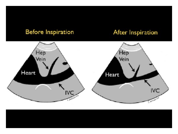 Ultrasound image of a collapsible inferior vena cava suggesting volume responsiveness