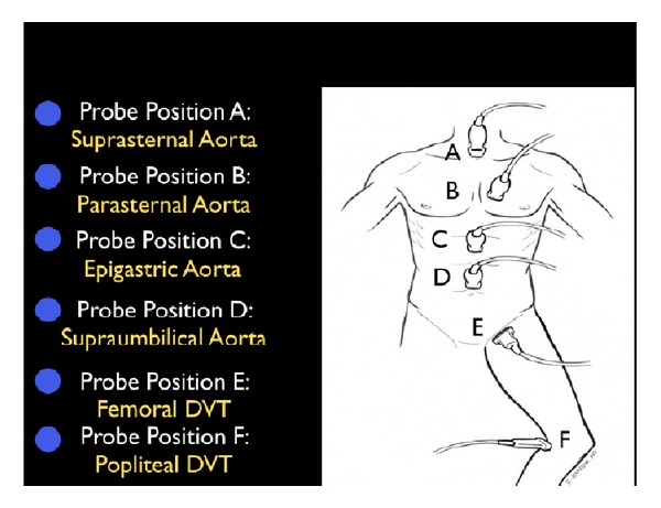 RUSH protocol pipes evaluation showing aortic assessment and DVT evaluation