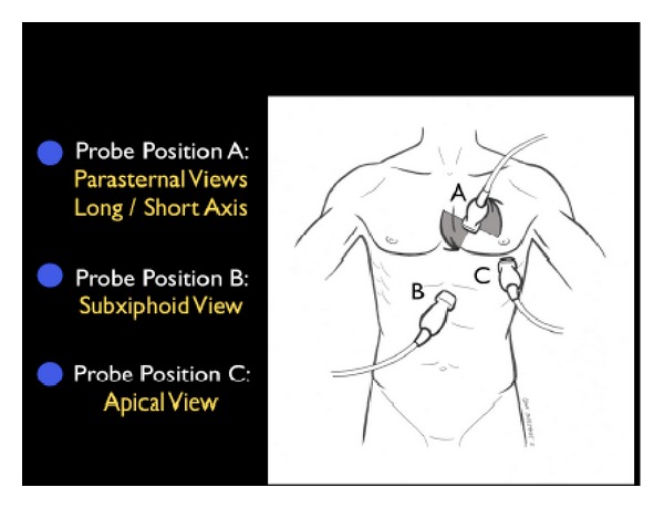 RUSH protocol pump evaluation showing cardiac ultrasound views for assessing ventricular function and pericardial effusion