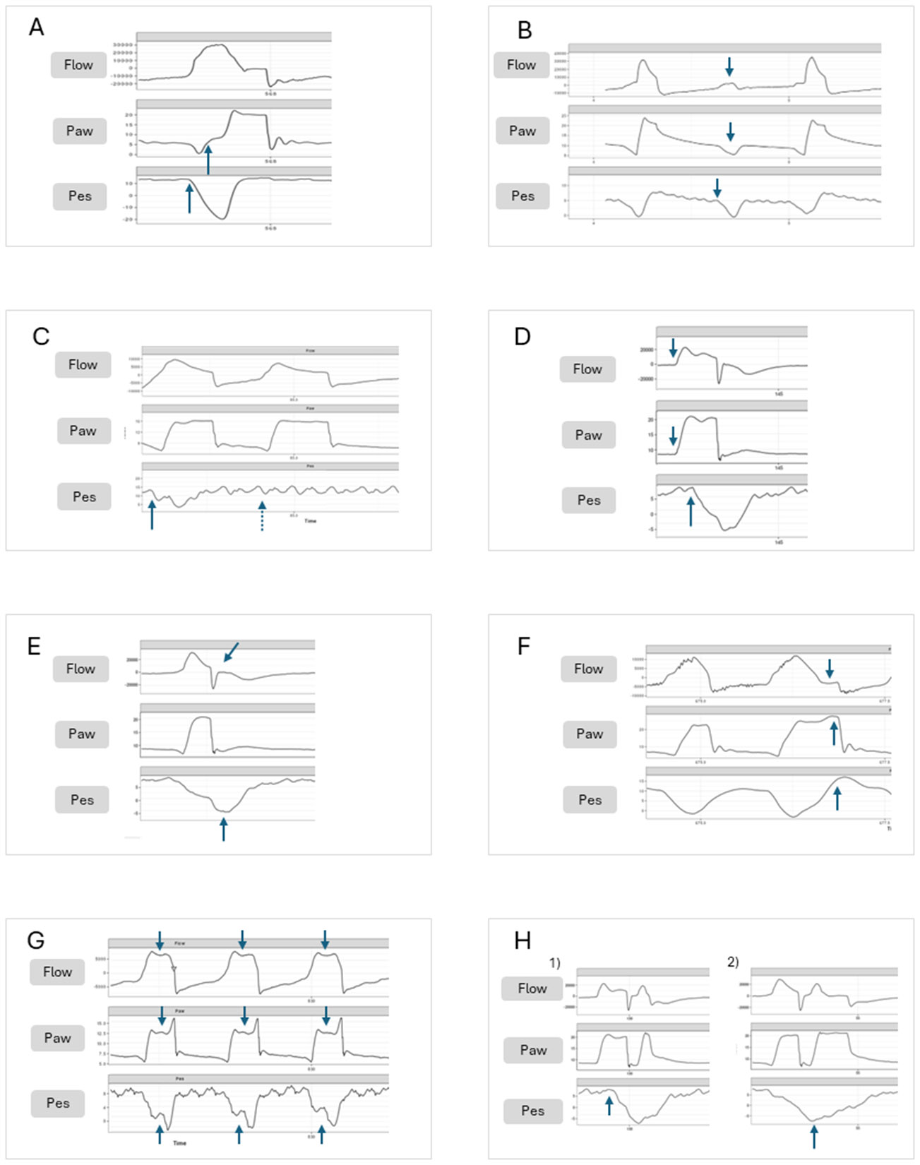 Ventilator waveform tracings demonstrating eight types of patient-ventilator asynchrony including delayed triggering, ineffective triggering, auto-triggering, reverse triggering, premature and delayed termination, flow undershoot, and breath stacking