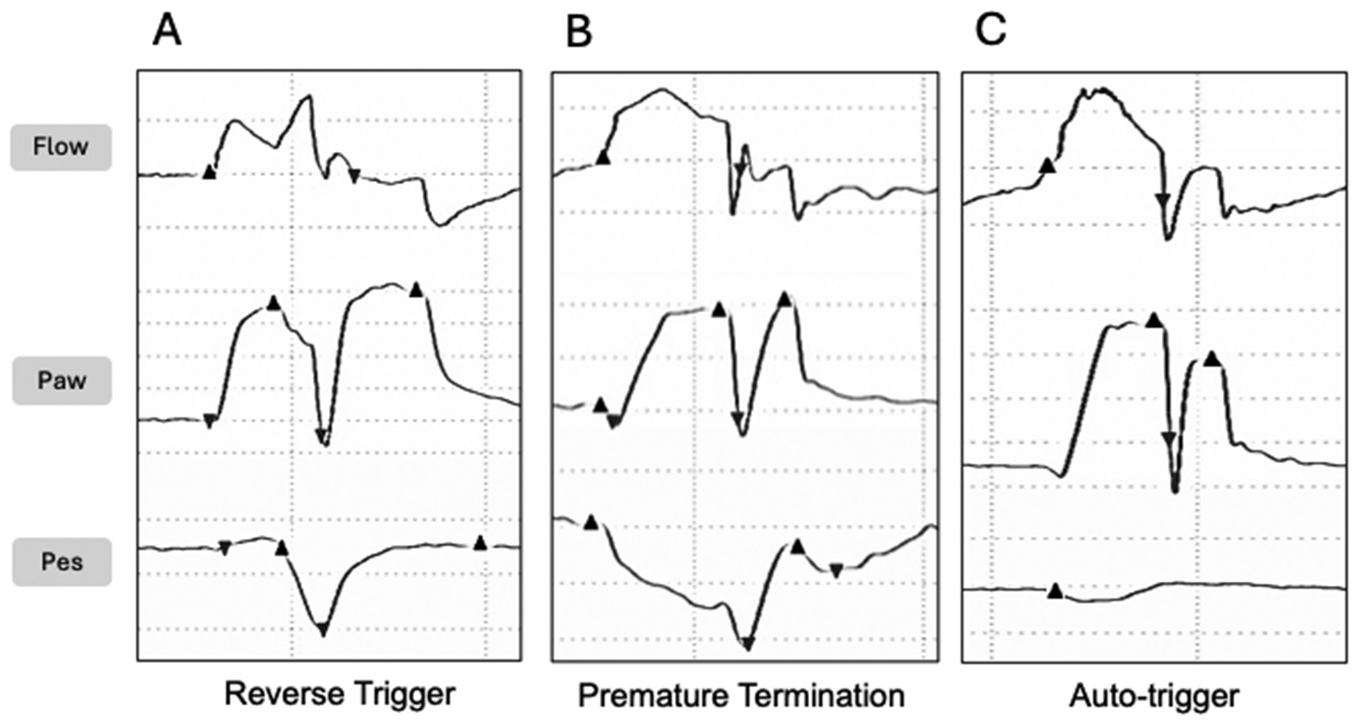 Three mechanisms causing double cycling on mechanical ventilation shown with ventilator waveform tracings including reverse trigger, premature termination, and auto-trigger patterns