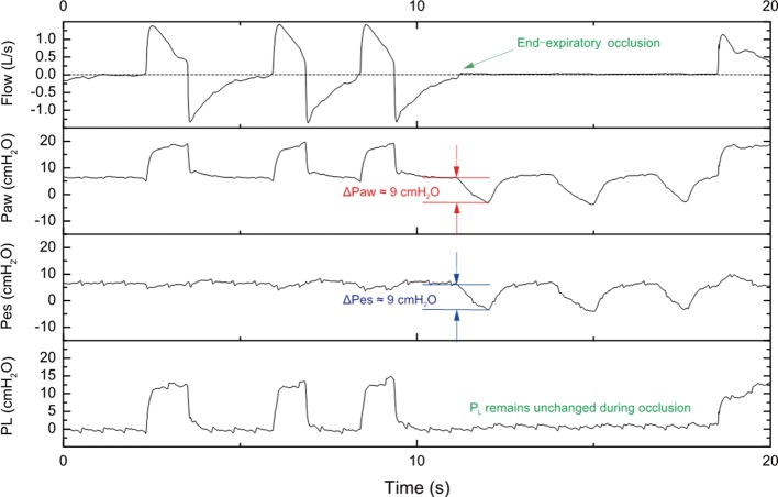 Ventilator pressure and flow waveform tracings comparing volume-controlled and pressure-controlled ventilation modes during mechanical ventilation