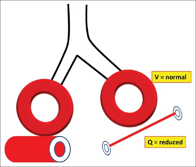Diagram showing dead space ventilation with ventilation of non-perfused alveoli as in pulmonary embolism
