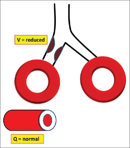 Diagram showing low ventilation-perfusion ratio with reduced ventilation relative to blood flow in a lung unit