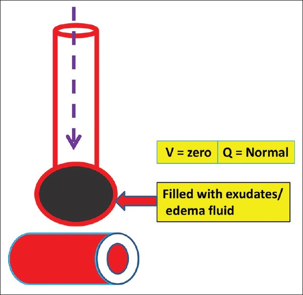 Diagram showing intrapulmonary shunt with perfusion of non-ventilated alveoli