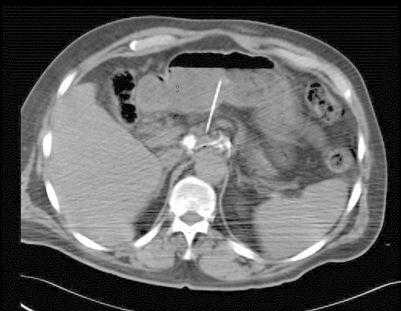Celiac plexus neurolysis technique showing bilateral posterior approach at T12-L1