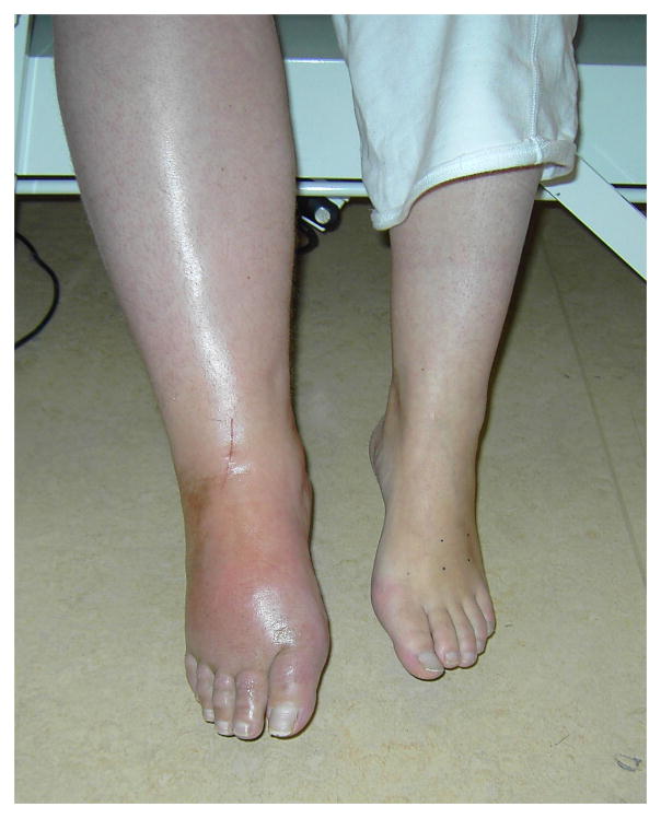 Acute CRPS showing hyperemia, swelling, and glossy skin of the hand