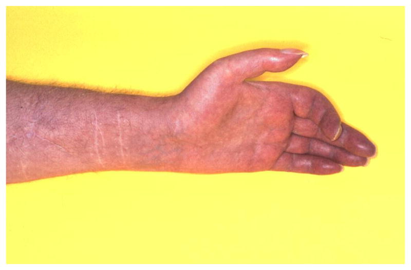Chronic cold-type CRPS showing blue discoloration and trophic changes of the fingers