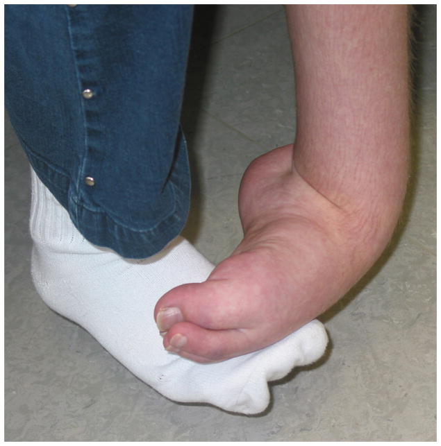 CRPS-related dystonia of the left ankle and foot with plantar flexion and inversion