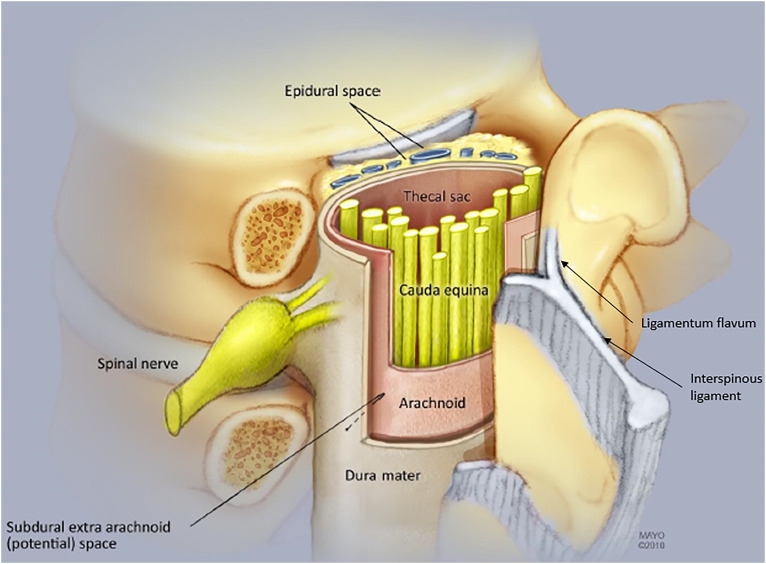 Anatomy of the epidural space showing needle approach for epidural steroid injection