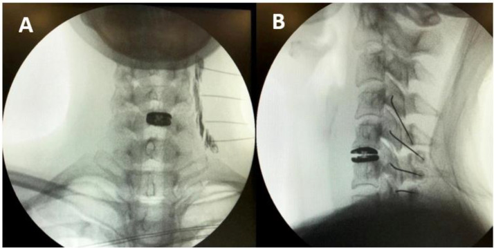 Cervical facet radiofrequency ablation technique