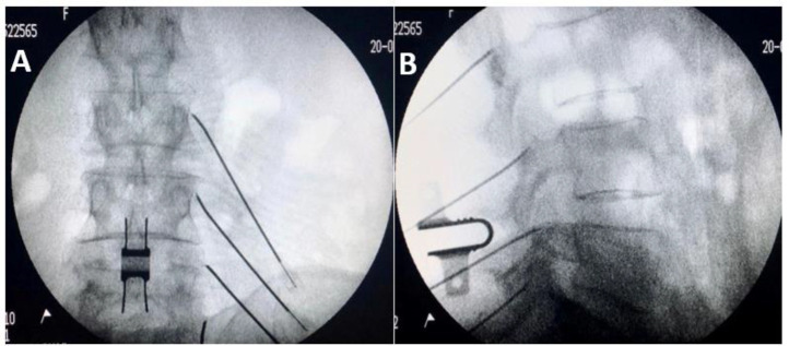 Lumbar facet radiofrequency ablation showing cannula placement parallel to medial branch nerve