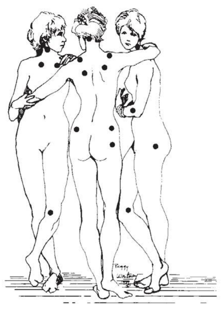 Location of the 18 fibromyalgia tender points on a body diagram
