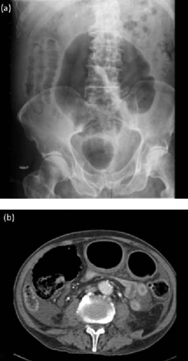 Abdominal radiograph and CT scan demonstrating toxic megacolon as a complication of fulminant Clostridioides difficile infection