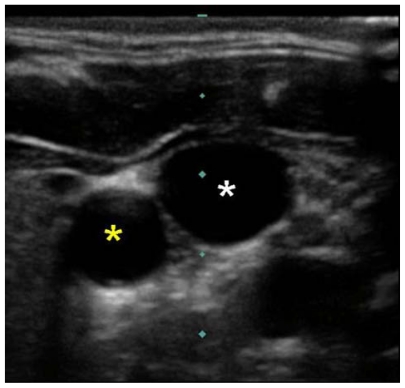Ultrasound image showing the internal jugular vein and carotid artery in cross-section for ultrasound-guided central line placement
