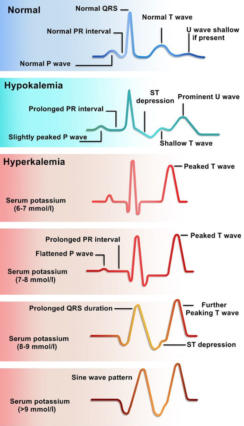 ECG changes in hyperkalemia and hypokalemia showing progressive waveform abnormalities at different potassium levels