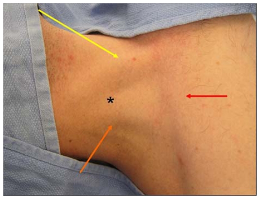 Surface anatomy of Sedillot triangle showing landmarks for internal jugular vein cannulation