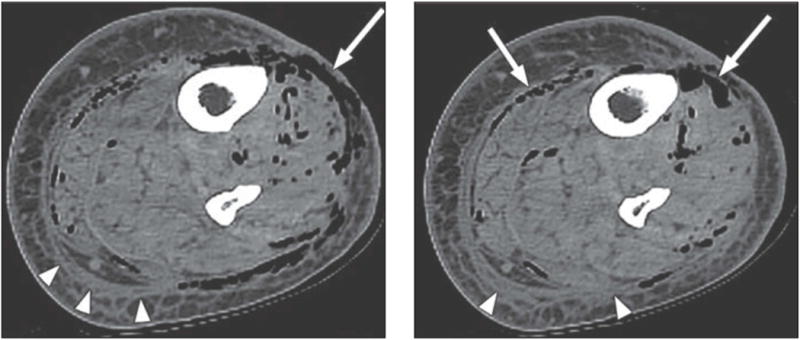 CT scan showing soft tissue gas and fascial thickening characteristic of necrotizing fasciitis