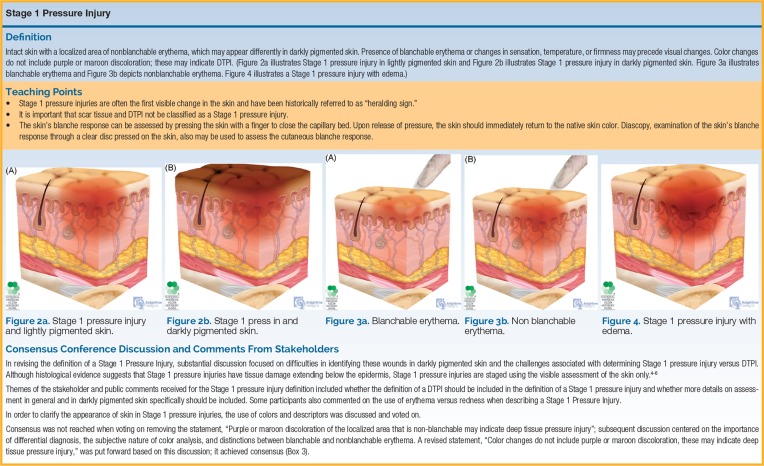 Cross-sectional illustration showing the revised NPUAP pressure injury staging system with tissue depth involvement