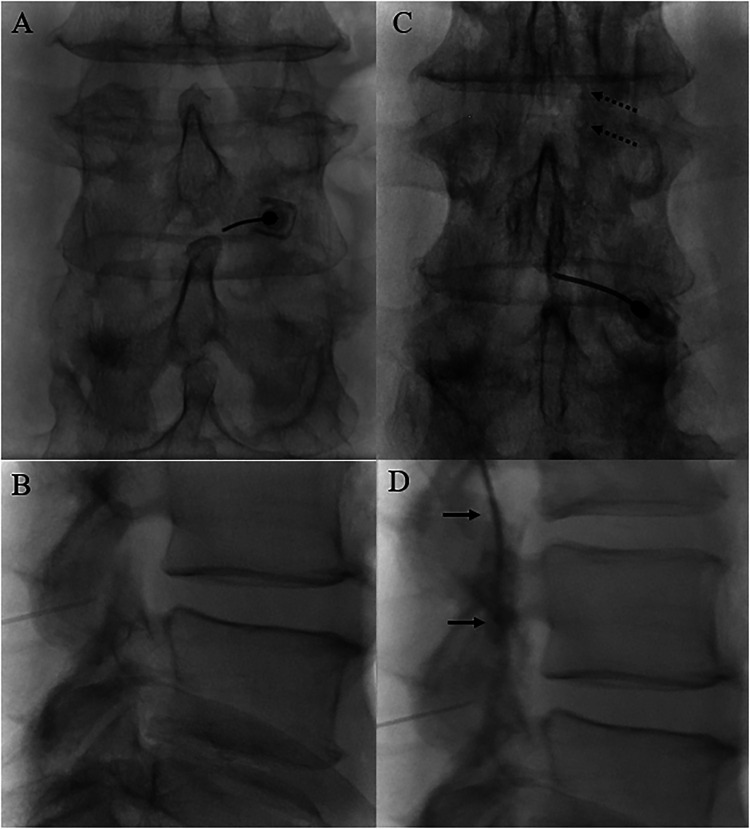 Interlaminar epidural steroid injection under fluoroscopic guidance