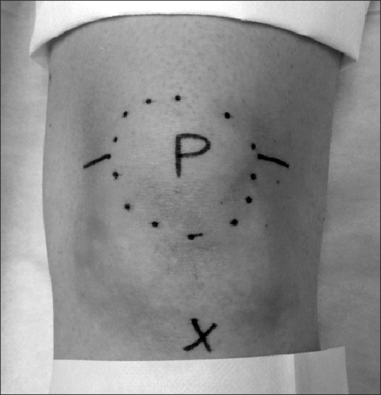 Knee injection approaches showing suprapatellar, inferolateral, and medial midpatellar portals