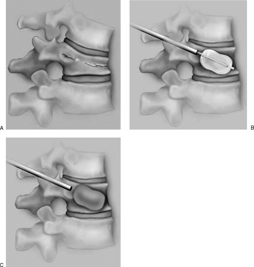 Kyphoplasty procedure showing balloon tamp inflation and PMMA cement injection