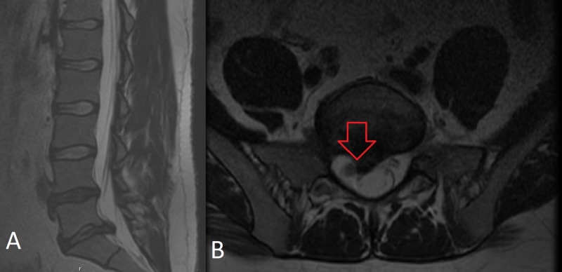 MRI of L5-S1 lumbar disc herniation with nerve root compression