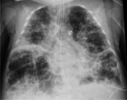 Chest radiograph of an infant with established bronchopulmonary dysplasia showing hyperinflation with mixed areas of density and hyperlucency