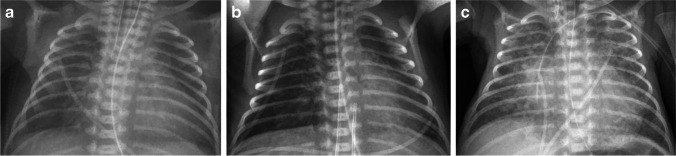 Serial chest radiographs showing evolving lung appearance in a premature newborn from initial RDS through development of BPD