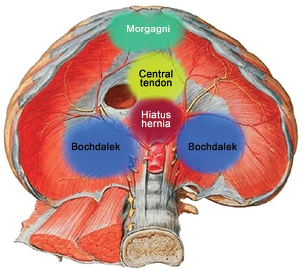 Schematic representation of anterior Morgagni, posterolateral Bochdalek, and central diaphragmatic hernia locations