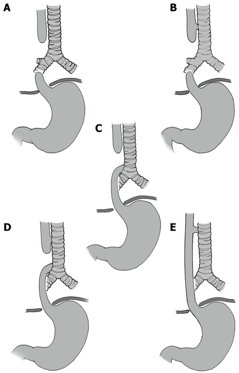 Classification of esophageal atresia and tracheoesophageal fistula showing five types: A through E with anatomic diagrams