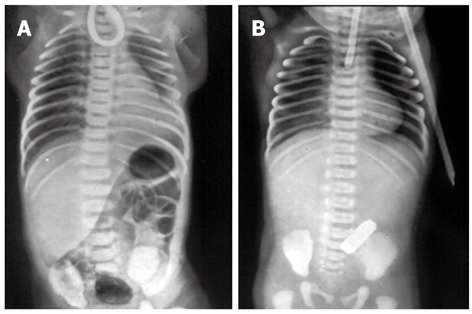 Chest and abdominal radiographs of neonates with esophageal atresia showing coiled orogastric catheter in blind esophageal pouch