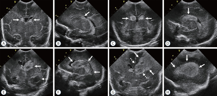 Cranial ultrasound images demonstrating the four grades of germinal matrix-intraventricular hemorrhage in preterm infants