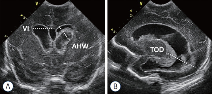 Cranial ultrasound measurement techniques for monitoring ventricular size including ventricular index and anterior horn width