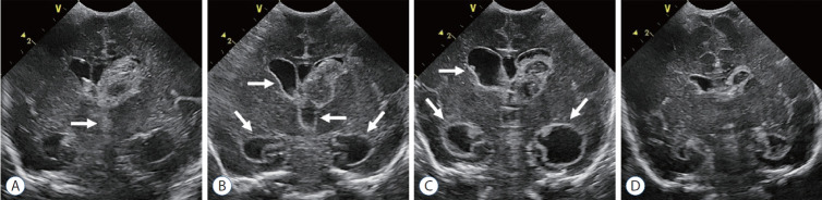 Serial cranial ultrasound images showing the natural history of posthemorrhagic ventricular dilation from acute hemorrhage through spontaneous resolution