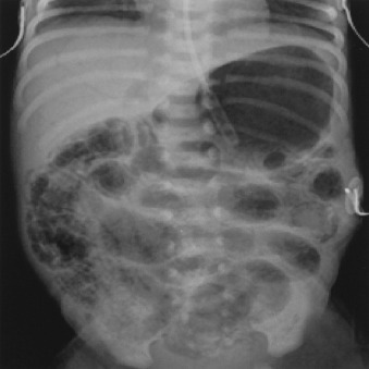 Abdominal radiograph demonstrating extensive pneumatosis intestinalis and portal venous gas in necrotizing enterocolitis