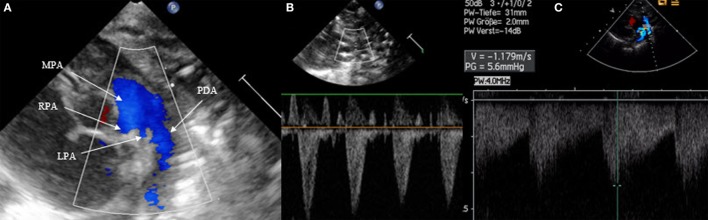 Doppler echocardiography showing right-to-left shunting across patent ductus arteriosus with flow patterns below baseline