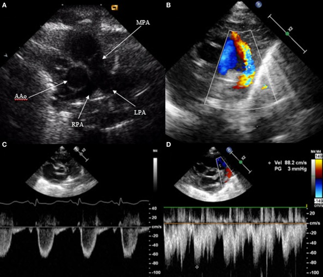 Echocardiographic visualization of patent ductus arteriosus in short axis view with 2D and color Doppler imaging showing ductal flow