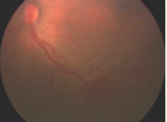 Fundoscopic image showing plus disease in retinopathy of prematurity with dilated and tortuous posterior pole retinal vessels