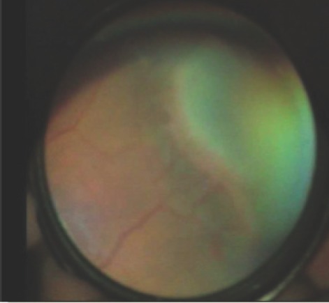 Fundoscopic image showing Stage 3 retinopathy of prematurity with extraretinal fibrovascular proliferation extending from the ridge